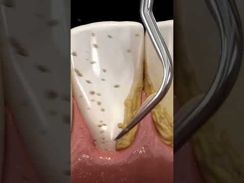 Ultrasonik Aletle Diş Temizliği